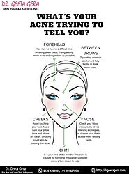 For those patients whose #acne has gone... - Dr. Geeta Gera Skin, Hair & Laser Clinic | Facebook