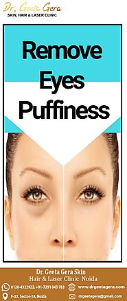 #Puffyeyes occur by many reasons,... - Dr. Geeta Gera Skin, Hair & Laser Clinic | Facebook