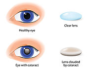 Website at https://www.drtonyseyehospital.com/general-information/major-eye-diseases/cataract