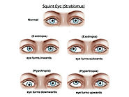 Website at https://www.drtonyseyehospital.com/general-information/major-eye-diseases/squint