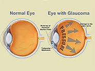 Website at https://www.drtonyseyehospital.com/general-information/major-eye-diseases/glaucoma