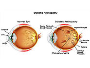 Website at https://www.drtonyseyehospital.com/eye-speciality/vitreo-retina/diabetic-retinopathy-treatment