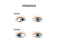 Website at https://www.drtonyseyehospital.com/eye-speciality/strabismus/strabismus-in-children-treatment