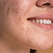 Effective Acne Scar Treatment in Delhi NCR at UnCover by Meddo