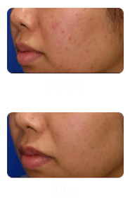 Treatment for Removal of Blackheads in Singapore