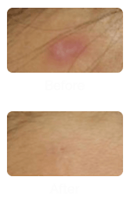 Acne Scar Treatment in Singapore