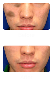 Laser Treatment for Pigmentation in Singapore