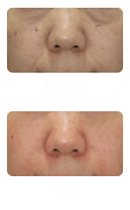 Wrinkles Treatment in Singapore