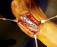 Do you Know About Removal of Orthopedic Implant?