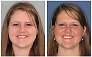 Invisalign — Dr. Kimberly Harper, DDS | Dentist Irving, TX