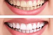 Why Teeth Whitening Irving Texas Treatment is Important? – Smiles of Irving