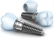 What Are The Best Dental Implants?