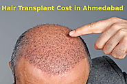 Want To Know Hair Transplant Cost in Ahmedabad Choose Avenues