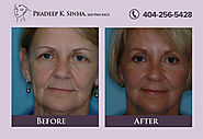 Fractional laser & resurfacing in Atlanta: Dr. Pradeep K. Sinha