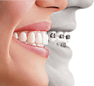 Best Invisalign orthodontist in Roanoke VA - Orthomv