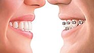 How Does Invisalign Work And Is It Better Than Braces?