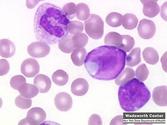 Acute Lymphoblastic Leukemia (ALL)