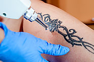 Tattoo Removal Laser Treatments in Bangalore - Dr.Priya's Skin and Hair Clinic