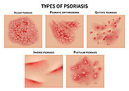 Psoriasis - Dr. Priya's Skin and Hair Clinic Bangalore
