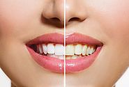Best Teeth Whitening Kit at Home for Her