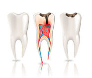 Eliminate Your Fears And Doubts About Irving Root Canal Therapy!