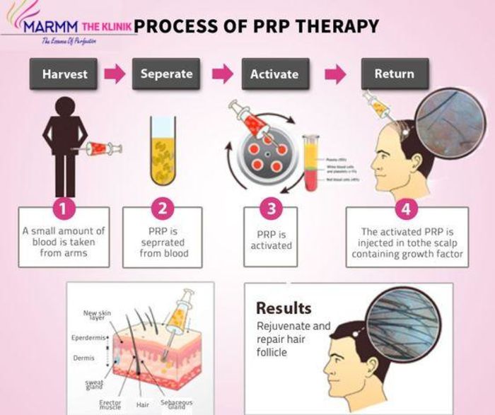 Plateletrich plasma therapy an effective treatment for Hair Loss A Listly List