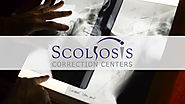 Non-Surgical Treatment of Scoliosis 43 Degree Curve