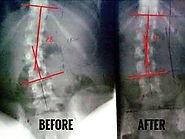 Reasons to Opt for Scoliosis Surgery Alternatives Treatments