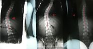 How to Effectively Treat Your Scoliosis Non-Surgically?