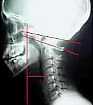 Know The Physics Of scoliosis & its Corrective Surgery