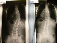 Things To Know About X-Ray Before You Go For Scoliosis Correction Treatment