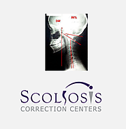 Long Term Side Effects Of Scoliosis And Invasive Treatments