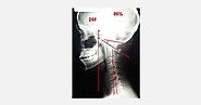 Scoliosis In Adults: Symptoms, Causes And Its Treatment