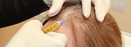 PRP Treatment for Hair Loss in Dubai & Abu Dhabi - PRP Injection | Hair Transplant Dubai Clinic