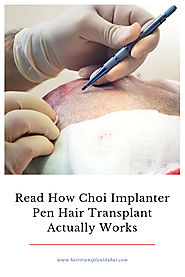 Read How Choi Implanter Pen Hair Transplant Actually Works | Hair Transplant Clinic