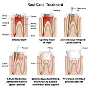 5 Common Illusions About Root Canal Melbourne Which Keeps Patients Away From Treatment