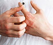 Website at https://www.drdeepikalunawat.com/for-your-skin/psoriasis-eczema-skin-skin-infections