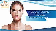 Laser Pigmentation In Chennai | Skin Specialist In Tamilnadu | Best Skin Clinic In India