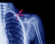 Surgery for Clavicle Fracture (Broken Collarbone): Types and Post-Surgical Pain