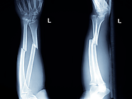 What is the symptoms and Treatments of Hand Fractures | Siiora.lk