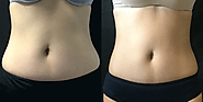 Website at https://smartkela.com/coolsculpting-side-effects-and-treatment-options/