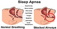 What Is Sleep Apnea, its Causes and Treatment Options
