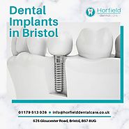 Dental Implants in Bristol