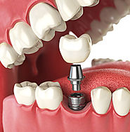 Dental Implants in Bristol