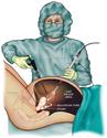 Laparoscopy