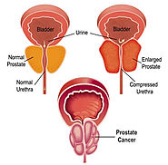 Get the best prostate cancer treatment Cape Town
