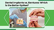 Dental Implants vs. Dentures: Which is the Better Option?