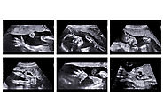 3rd month ultrasound scan in chennai