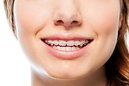 3 ORTHODONTIC TREATMENTS THAT CAN CORRECT MALOCCLUSIONS - Strong Article