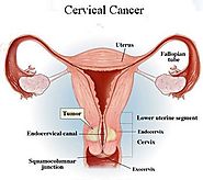 Website at https://www.cancer-treatment-madurai.com/types-of-cancer-cervical-cancer.html